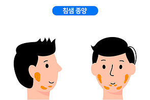 침샘 종양